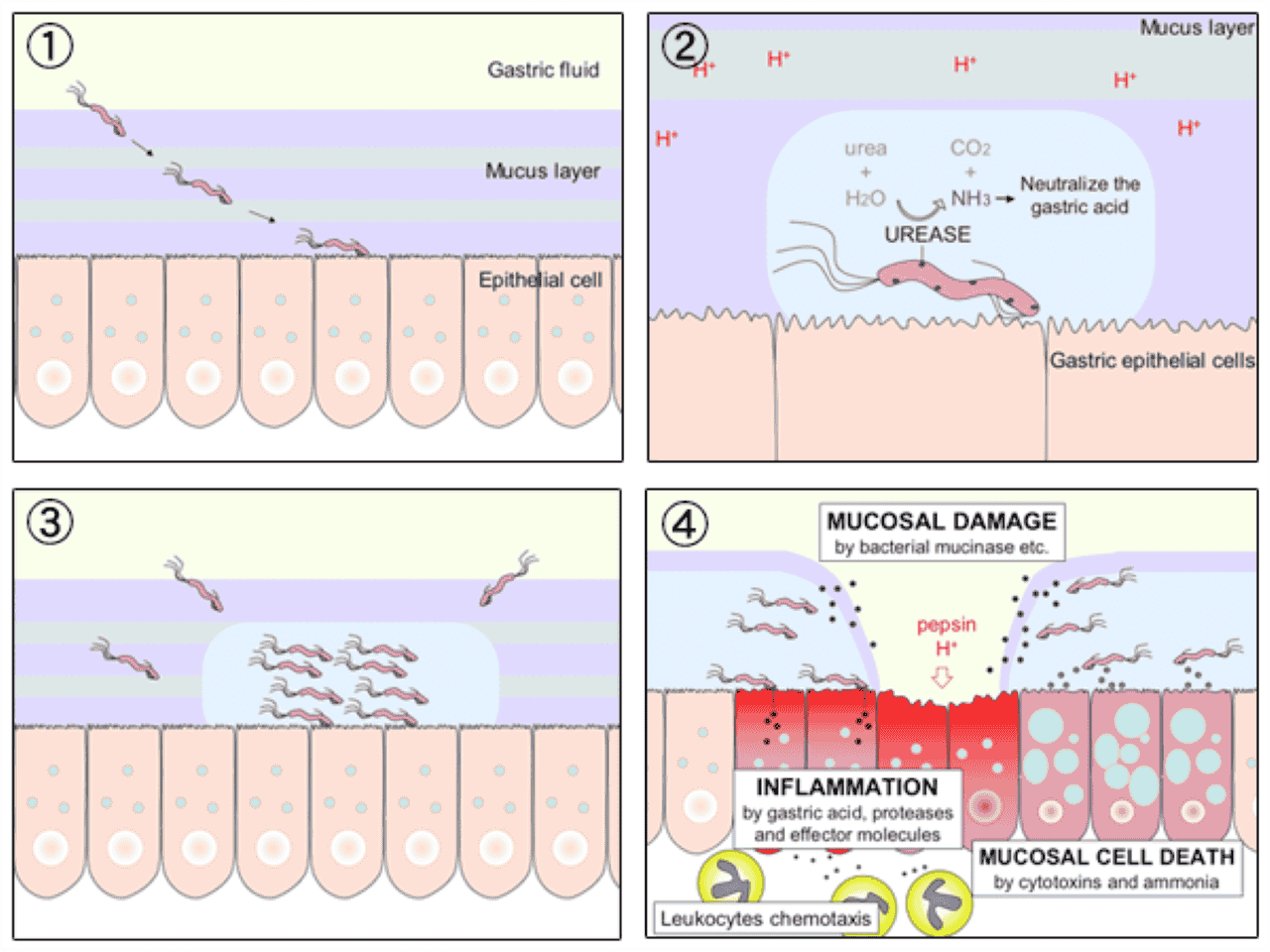 H Pylori Ulcer Diagram En (1)